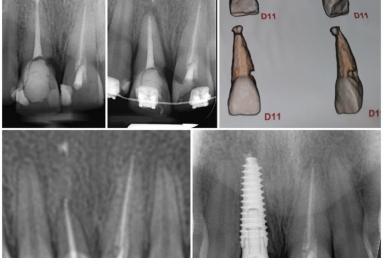 Megagen Anyridge dental implant