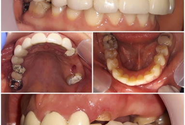 Zirconium crowns on teeth and implants