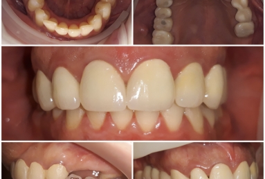 Zirconium crowns on teeth and implants
