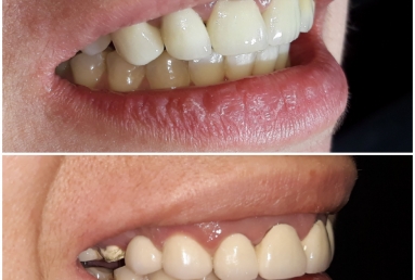 Zirconium crowns on teeth and implants