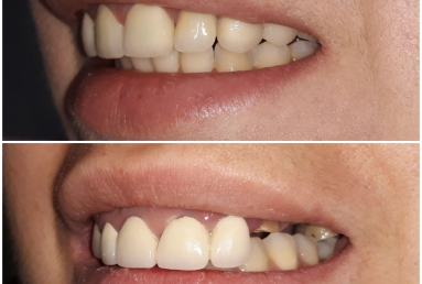 Zirconium crowns on teeth and implants