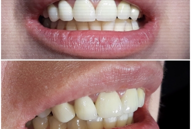 Zirconium crowns on teeth and implants