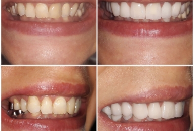 Ceramic crowns and veneers, dental implants