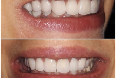 Ceramic crowns and veneers, dental implants