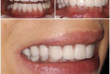 Ceramic crowns and veneers, dental implants