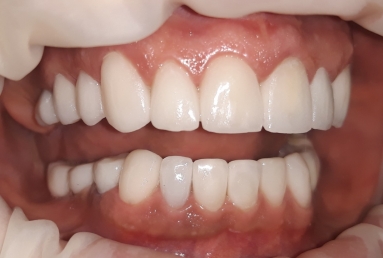 Ceramic crowns and veneers, dental implants