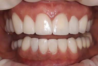 Ceramic crowns and veneers, dental implants