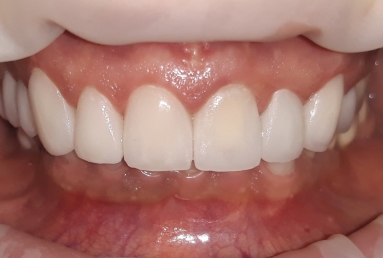 Ceramic crowns and veneers, dental implants