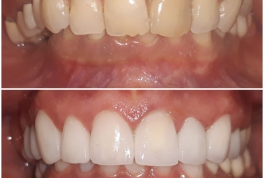 Ceramic crowns and veneers, dental implants