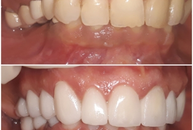Ceramic crowns and veneers, dental implants