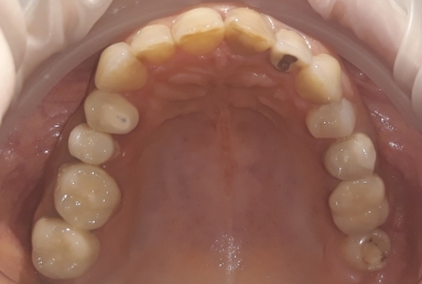 Ceramic crowns and veneers, dental implants
