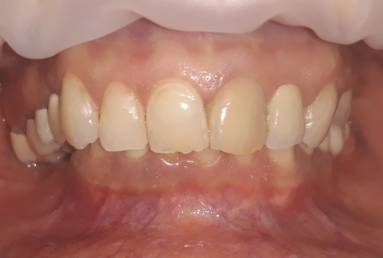 Ceramic crowns and veneers, dental implants