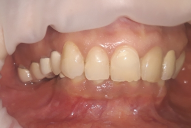 Ceramic crowns and veneers, dental implants