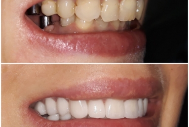 Ceramic crowns and veneers, dental implants