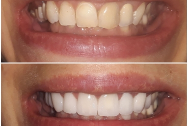 Ceramic crowns and veneers, dental implants