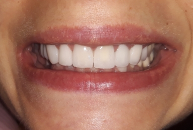 Ceramic crowns and veneers, dental implants