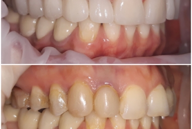 Full ceramic veneers and crowns