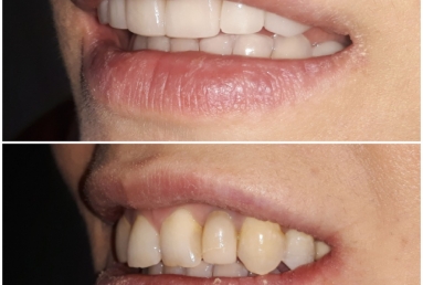 Full ceramic veneers and crowns