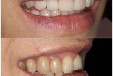 Full ceramic veneers and crowns