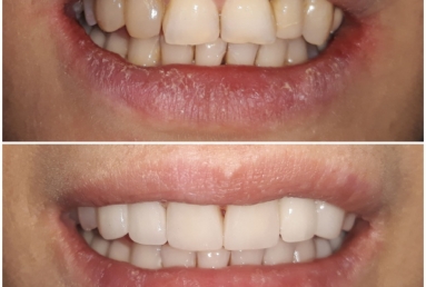 Full ceramic veneers and crowns