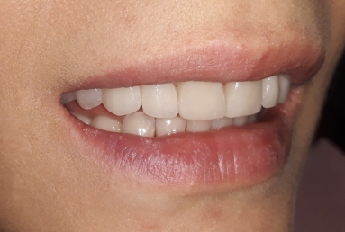 Full ceramic veneers and crowns