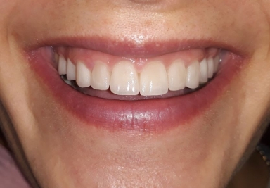 Ceramic crowns and veneers