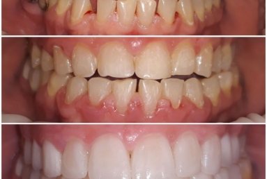 Ceramic crowns and veneers  Vezi imaginea
