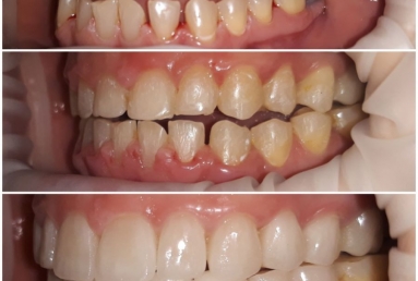 Ceramic crowns and veneers  Vezi imaginea