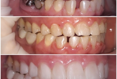 Ceramic crowns and veneers  Vezi imaginea