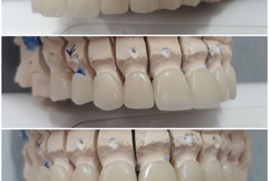Ceramic crowns and veneers  Vezi imaginea
