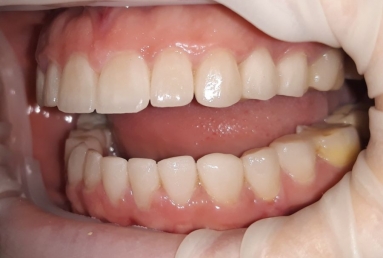 Ceramic crowns and veneers  Vezi imaginea