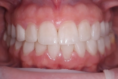 Ceramic crowns and veneers  Vezi imaginea