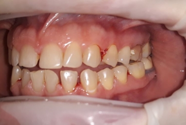 Ceramic crowns and veneers  Vezi imaginea