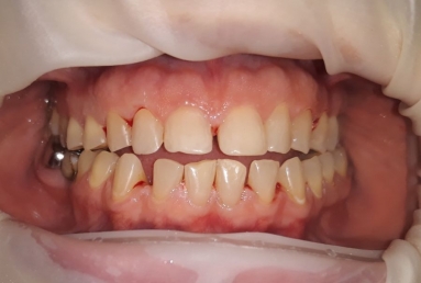 Ceramic crowns and veneers  Vezi imaginea