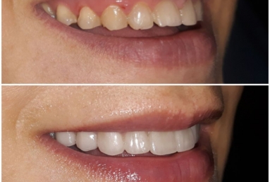 Ceramic crowns and veneers  Vezi imaginea