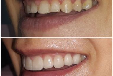 Ceramic crowns and veneers  Vezi imaginea